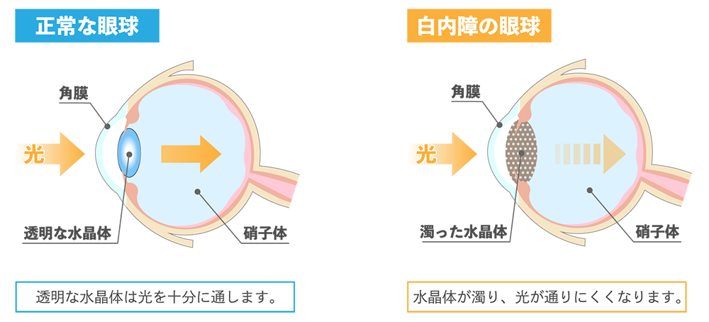 白内障とは？