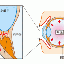 緑内障の原因と種類